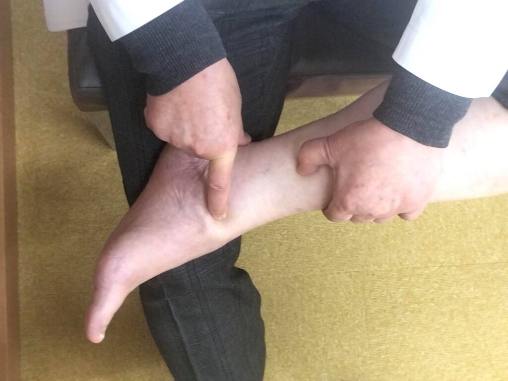 五十肩ポイント「肩の真上〜外側」