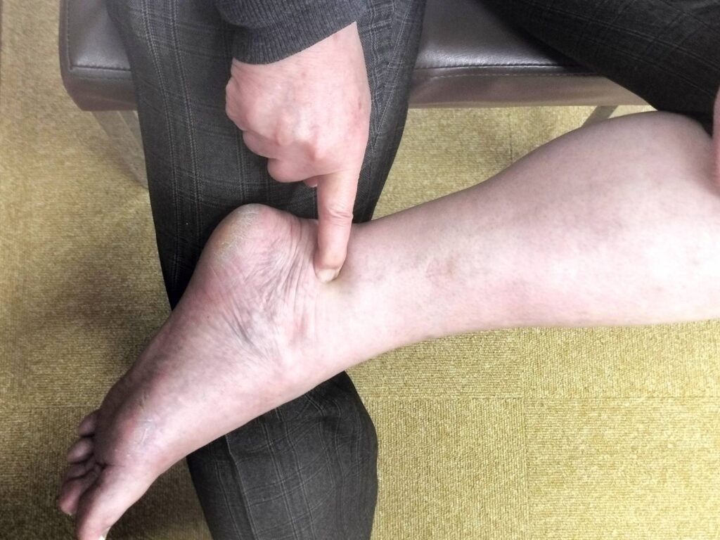 五十肩ポイント「肩の後ろ側」